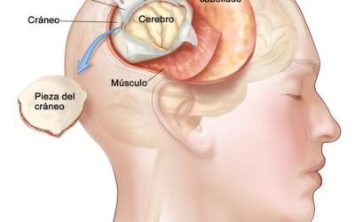 Un hospital de Gran Canaria realiza por primera vez una cirugía en un paciente despierto para extraerle un tumor cerebral